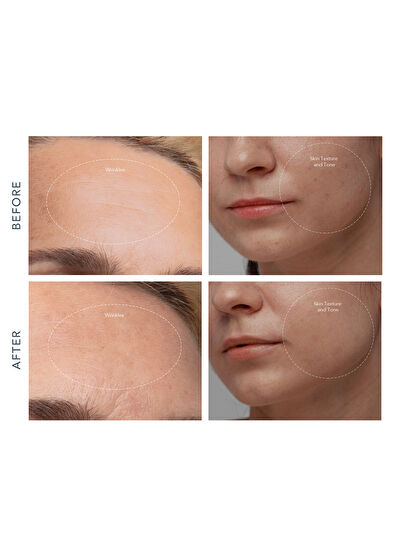 Foreo Kiwi Derma Skin Massager - 5