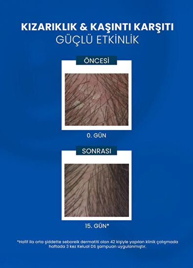 Ducray Kelual DS Shampoo Kepeklenme ve Kaşıntı Karşıtı Şampuan 100 ml - 5