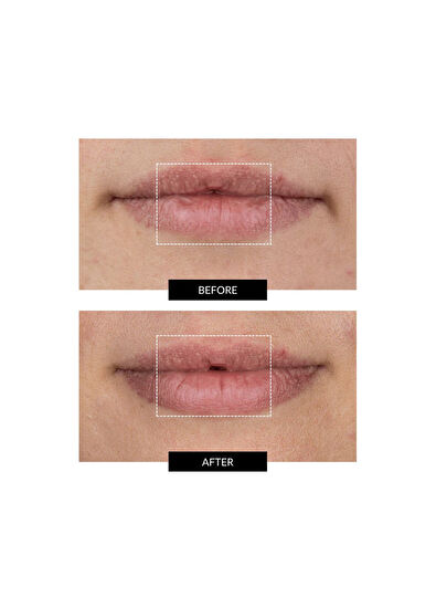 CurrentBody Skin LED Kırışıklık Karşıtı Dudak Çevresi Bakım Cihazı - 7