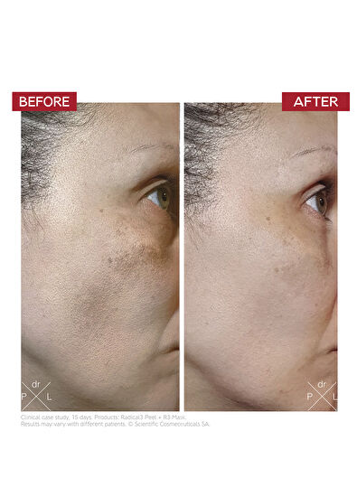 Dr.Levy Radical3 Reboot Pro Peel 50 ML - 5