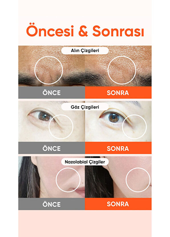 ACROPASS Retinol ve PDRN Mikro İğneli Alın Çizgisi Bandı Reti-rn Microcone Patch T Type 4’lü Göz Serumu - 4