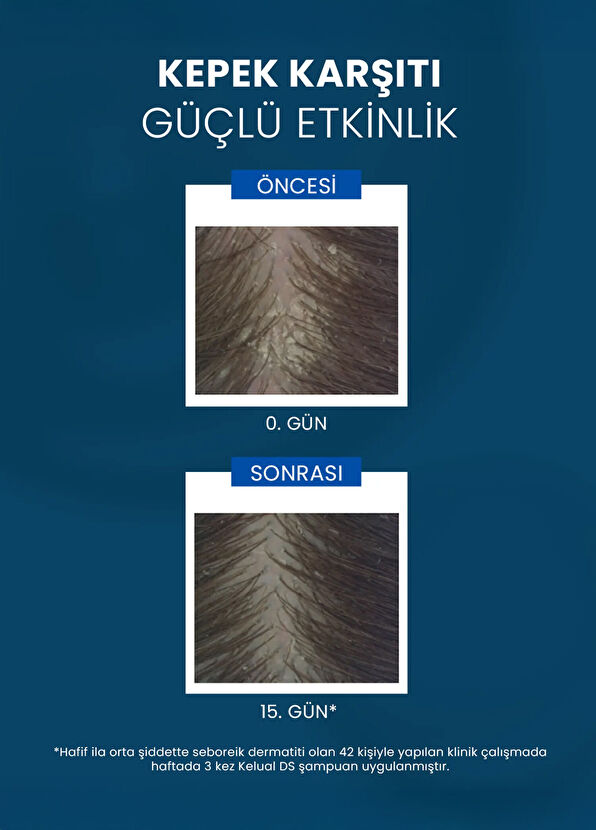 Ducray Kelual DS Shampoo Kepeklenme ve Kaşıntı Karşıtı Şampuan 100 ml - 4